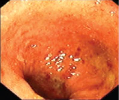 Endoscopie cas clinique 2